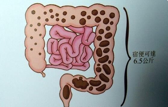 人体宿便有13斤?清肠排宿便,1个方法很有效!