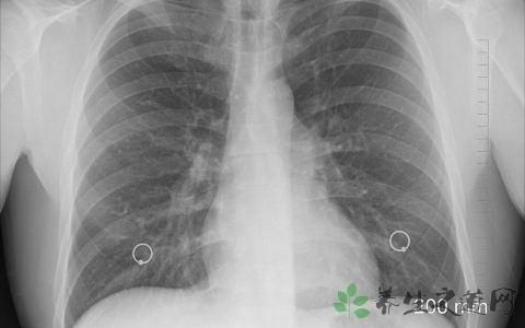 什么是间接性肺炎