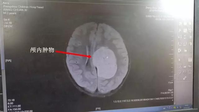 3岁了孩子还不会走路,祸起脑中大肿物!