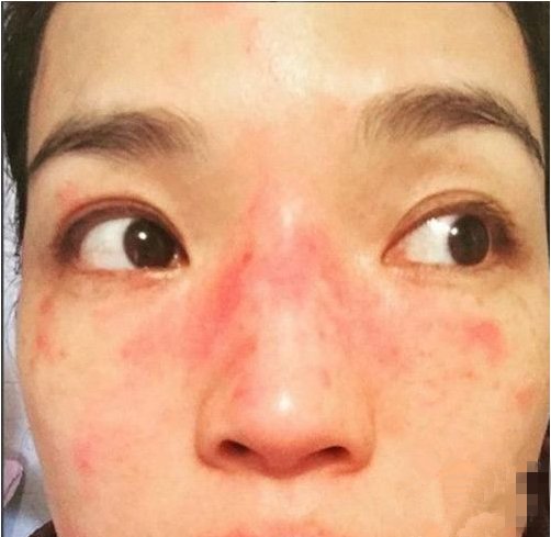 林志玲喝酒过敏,周迅抽烟爆痘痘,明星卸了妆,皮