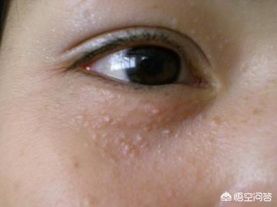 扁平疣,中医称为"鼠乳",本病由于肝失血养,体内潜藏病毒,风邪搏于肌肤