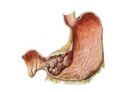 儿童感染了幽门螺旋杆菌跟这些生活习惯息息相