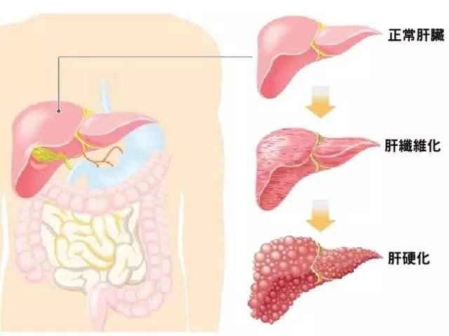 男子肝硬化,中医专家这样开药,现在彩超复查无