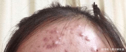 脸上这些位置长痘痘, 或暗示了不同的身体问