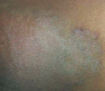 大腿内侧瘙痒红肿怎么办?巧妙护理快速迎来健