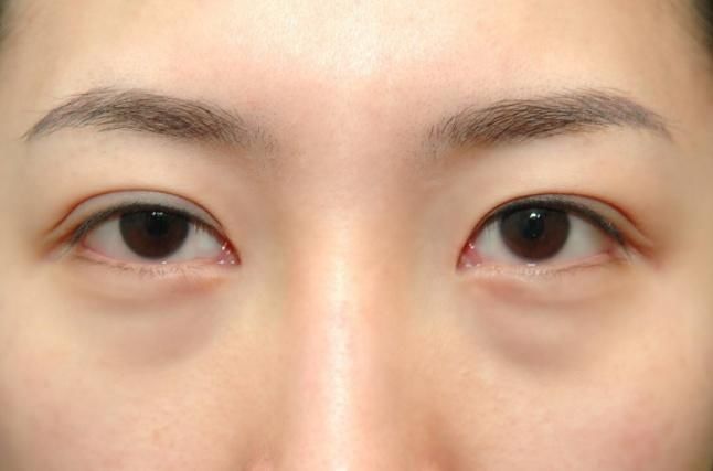 小姨每天蜂蜜抹脸,129秒去除眼袋、皱纹,醒来