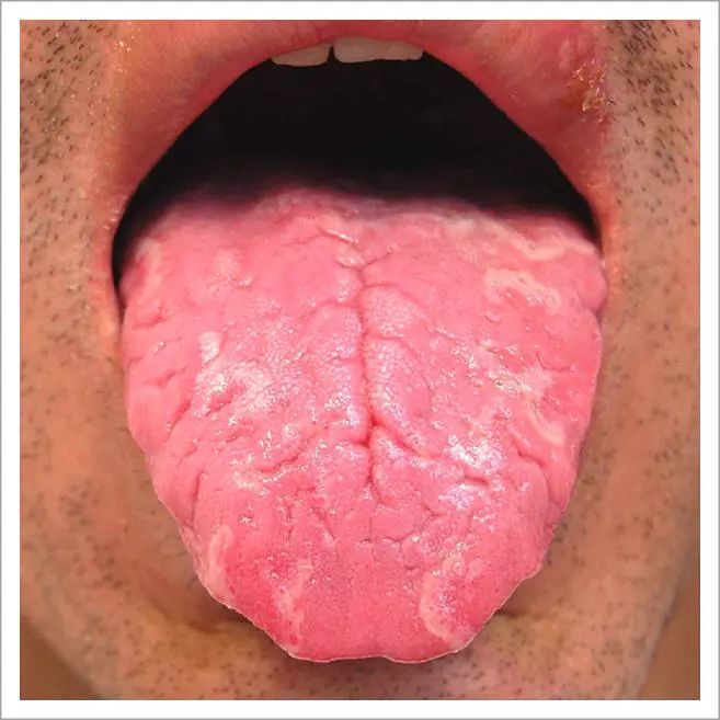 舌头出现这24种症状,就要警惕身体生病了!