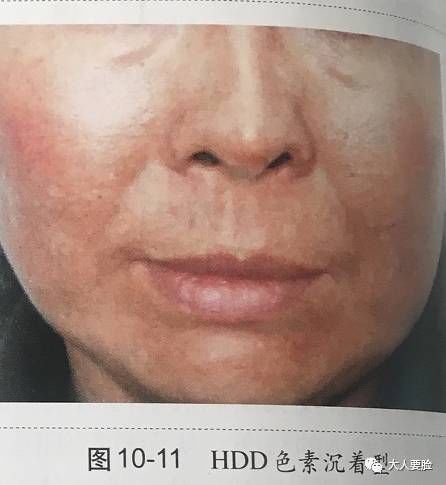 最新一批烂脸激素护肤品曝光,杨紫舒淇都用过