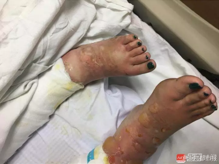 24岁的闫娇娇因"全身多处烧伤"被诊断为:烧伤面积达63%,大部分为重度
