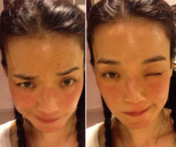 舒淇过敏浑身痒到无法入睡,不得不拿根针戳皮