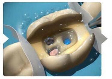 治疗孩子烂牙太凶的根管治疗是咋做的呢?