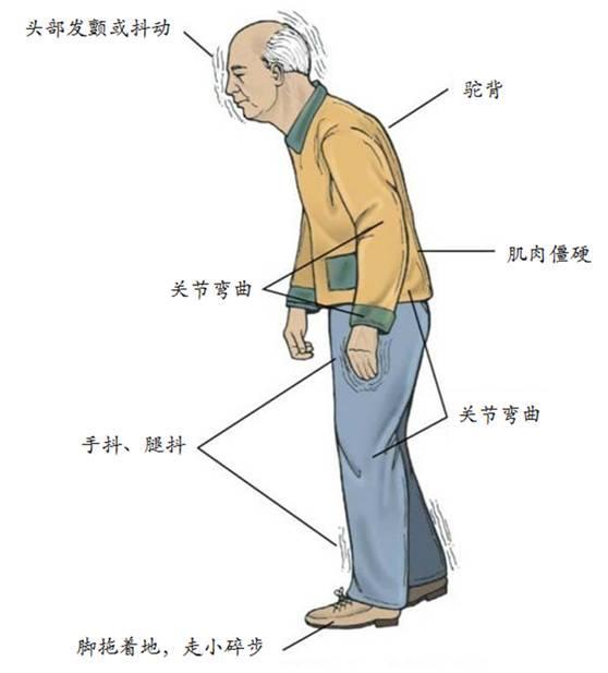 【慢病防控】認識帕金森病的表現