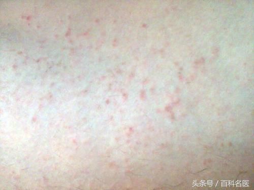 身上长了许多小红点,可能是脂肪肝、肝炎、肝