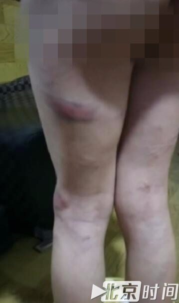 因学生未答对数学题,被老师用柳条抽打,导致屁股和大腿有多处淤青