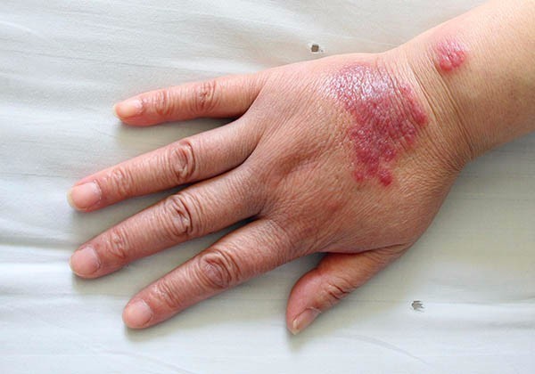 你得口腔溃疡有可能是得了性病