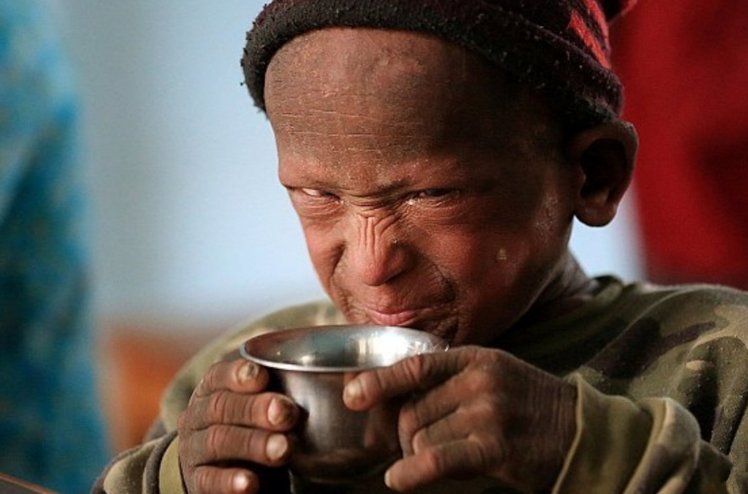 印度小孩皮肤硬化脱落变石头人,村民怕被传染