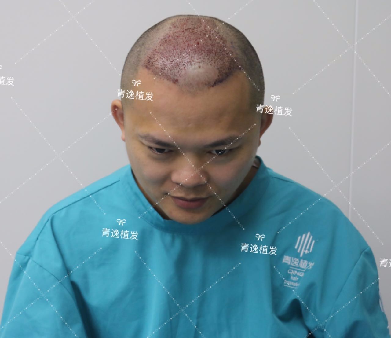 青逸植发种植头发之后效果能保持多久?