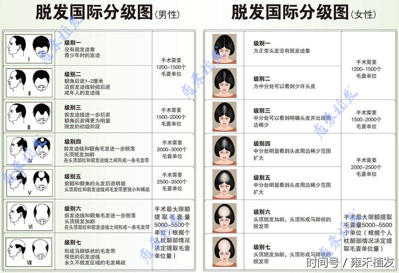 毛囊单位什么意思?植发1000单位能长1000根