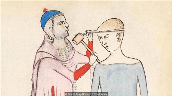 没有麻醉药:古人是如何打开活人头盖骨的?