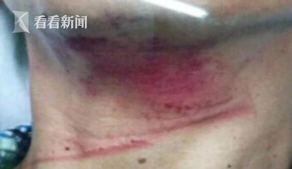 男子骑车下班遭钢丝绳割喉:打同事小报告被报复 男子骑车下班遭钢丝绳割喉:打同事小报告被报复