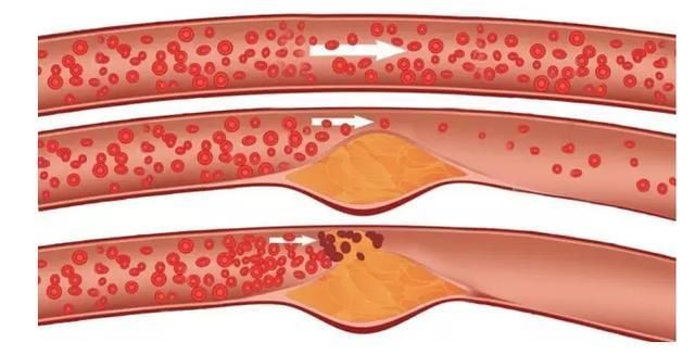 医生:五条满足三条以上,恭喜你,你的血管比同龄人健康,易长寿