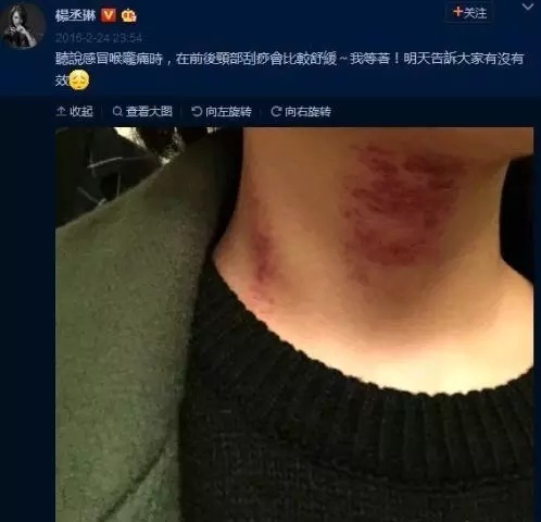 贾乃亮杨幂拔罐,刘涛佟大为刮痧,看大明星们都