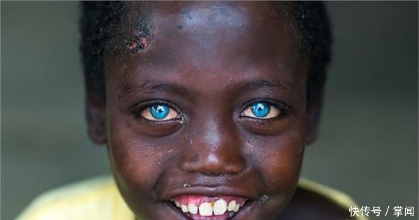 男孩1年没洗脸,眼睛变成蓝色,路人不敢直视,去过医院后只后悔