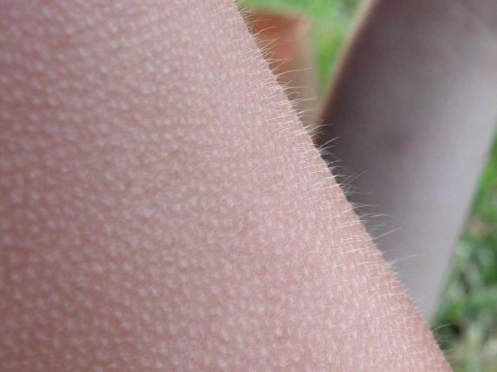 脖子鸡皮疙瘩皮肤怎样去除(脖子鸡皮疙瘩怎么消除最有效) 脖子鸡皮疙瘩皮肤怎样去除(脖子鸡皮疙瘩怎么消除最有效)