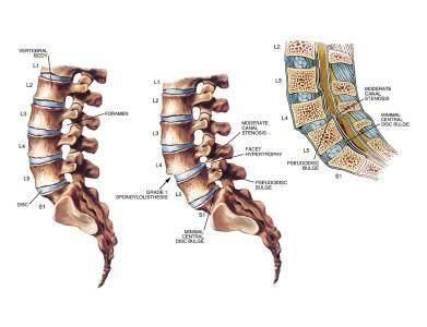 腰间盘突出，学会这个方法，快速缓解腰突症