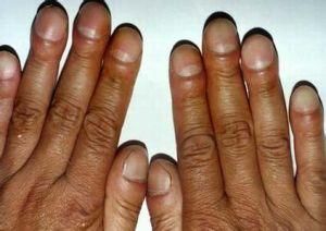 指甲有黑色竖纹,是身体的什么信号?