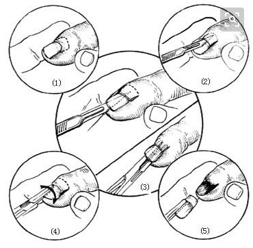 专家多年临床经验表明:治疗灰指甲,吃再多的药