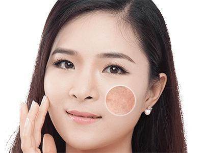 什么牌子的淡斑精华效果好 不如这些面部祛斑