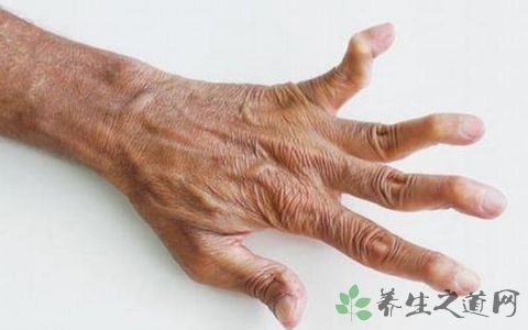 类风湿手腕肿怎么消肿