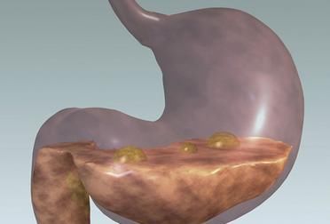 老中医: 治疗胃炎, 先消灭幽门螺杆菌, 一个偏方