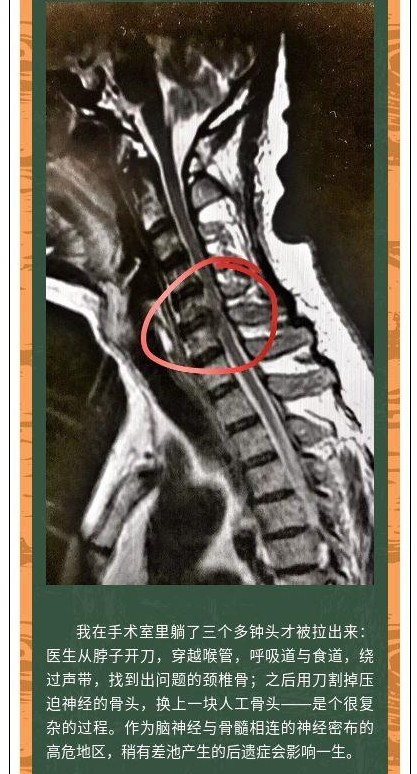 微博大V薛蛮子痴迷玩机导致严重颈椎间盘突出