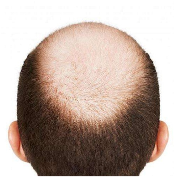 如何判断自己是否是雄性脱发?