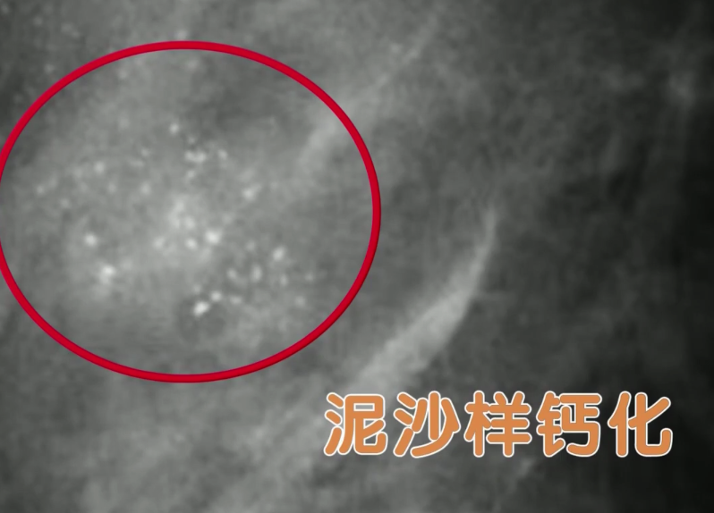干货 | 结节、囊肿、钙化、增生,离癌症有多远?_北京时间