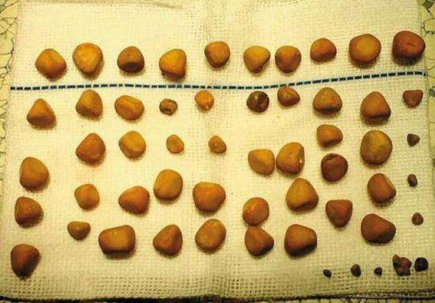 五旬男子身体取出143颗结石!喝水真的很重要!