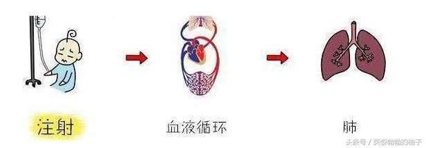 究竟什么是雾化?直接把药吸进去?这比起输液