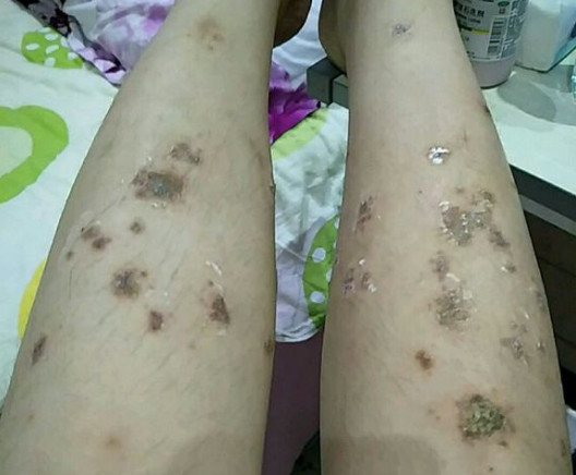 药物性皮疹的护理真经,一般人我不告诉他