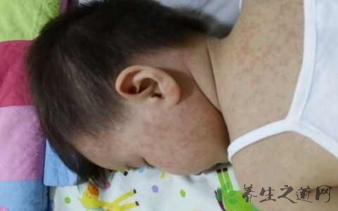 病毒疹不能吃什么