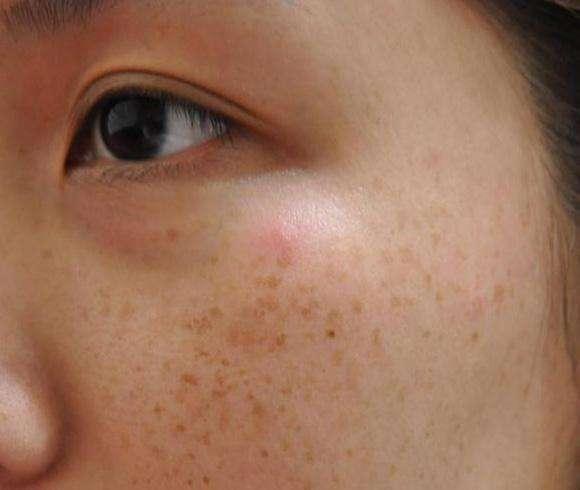 有的人是黄褐斑,有的人是汗斑,其实不管是什么斑点,都是脸上的黑色素