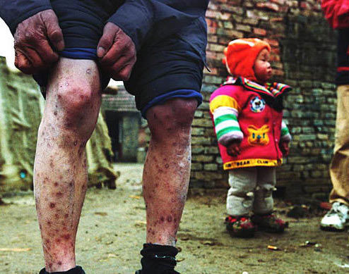 让人震惊!中国的艾滋病人真实写照