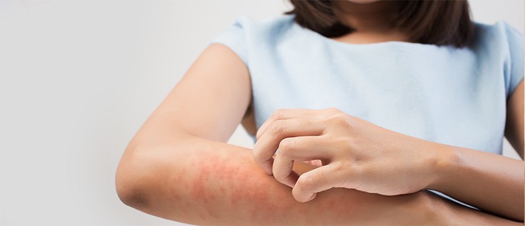 可怕！别把湿疹不当病 超过60种疾病与湿气有关