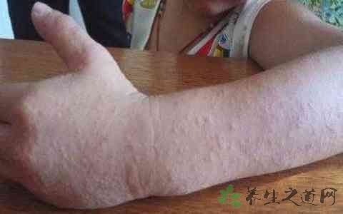 毛囊炎擦什么药膏