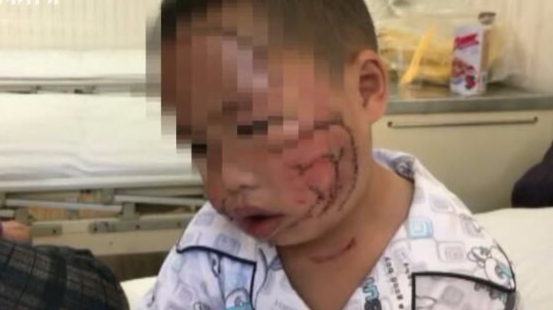 3岁男童玩耍时惨遭哈士奇撕咬 满脸被撕烂缝合200多针 3岁男童玩耍时惨遭哈士奇撕咬 满脸被撕烂缝合200多针
