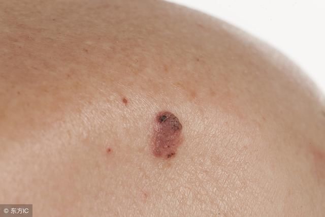 为何皮肤癌一经发现就是晚期?身上出现这个信