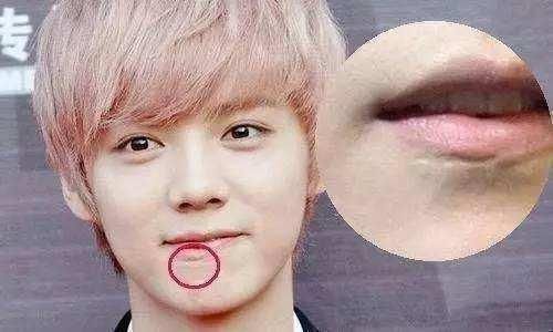 鹿晗下巴上的疤,网友:难道鹿晗也整容了?