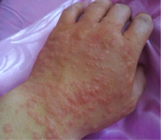 手背水泡湿疹怎么办,用这才能根除!必看! 手背水泡湿疹怎么办,用这才能根除!必看!