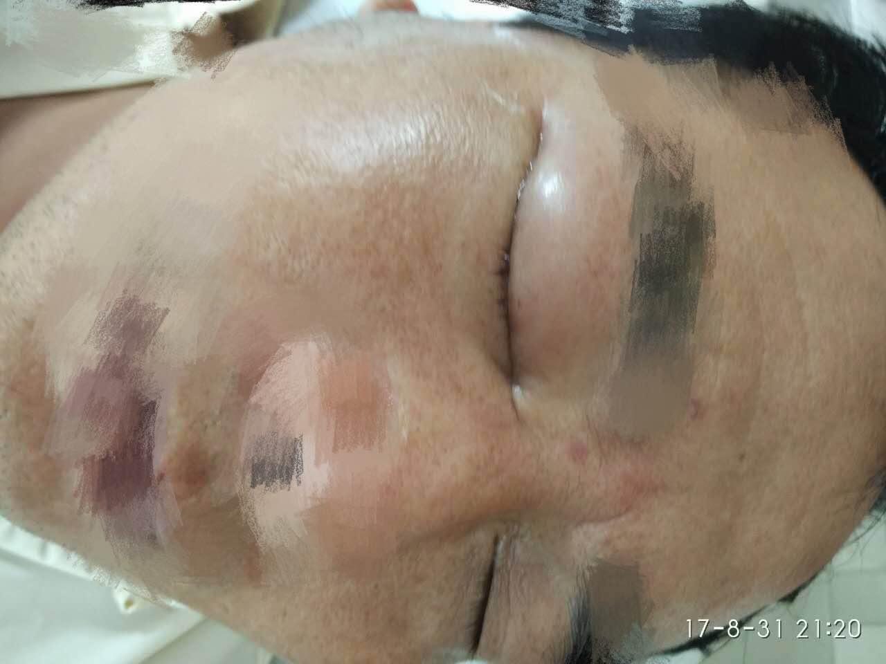 眼镜蛇喷来毒液中年男子因好奇面临右眼失明风险!
